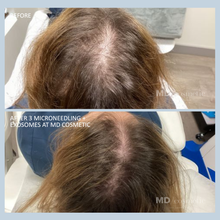 Load image into Gallery viewer, Hair Restoration with Exosomes: 3 at 25% Off