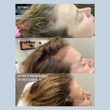 Load image into Gallery viewer, Hair Restoration with Exosomes: 3 at 25% Off