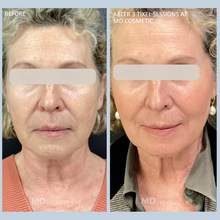 Load image into Gallery viewer, Buy 2 Tixel Face Treatments, Get 1 FREE
