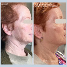 Load image into Gallery viewer, Morpheus8: Full Face &amp; Neck - 3 at 25% OFF

