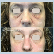 Load image into Gallery viewer, Morpheus8: Full Face &amp; Neck - 3 at 25% OFF
