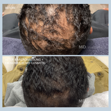 Load image into Gallery viewer, Hair Restoration with Exosomes: 3 at 25% Off
